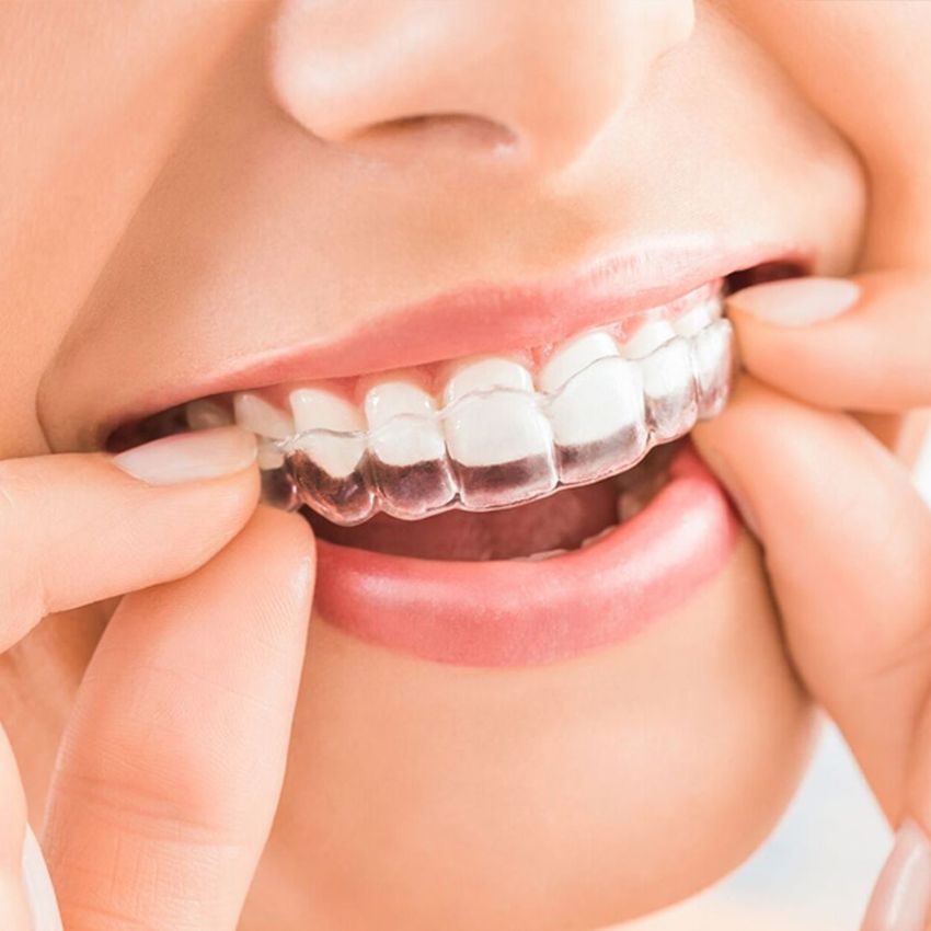 Invisalign Hacks That You Should Know About