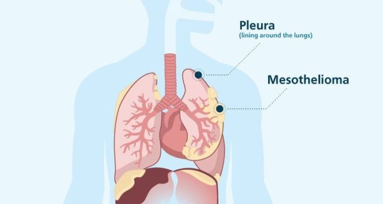 what are the warning signs of mesothelioma