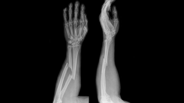 Hand and Arm Injuries - Motorcycle accidents