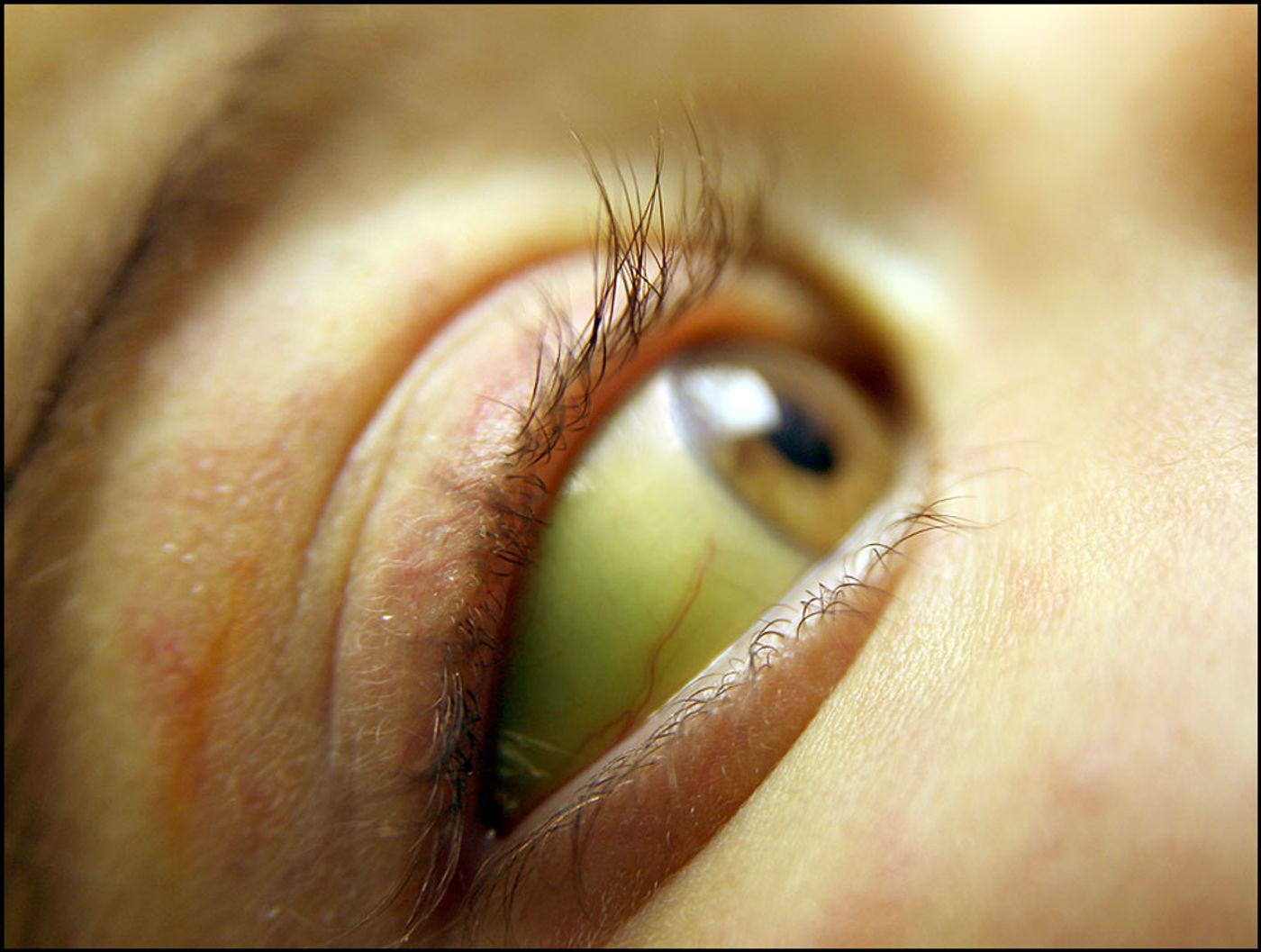 Почему глаза желтоватого. Пожелтение склер гепатит. Субиктеричность (желтушность) склер;. Иктеричность кожных склер.