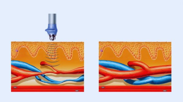 shockwave therapy - Mechanism of Action